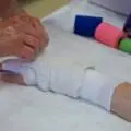 Hand Injury Update