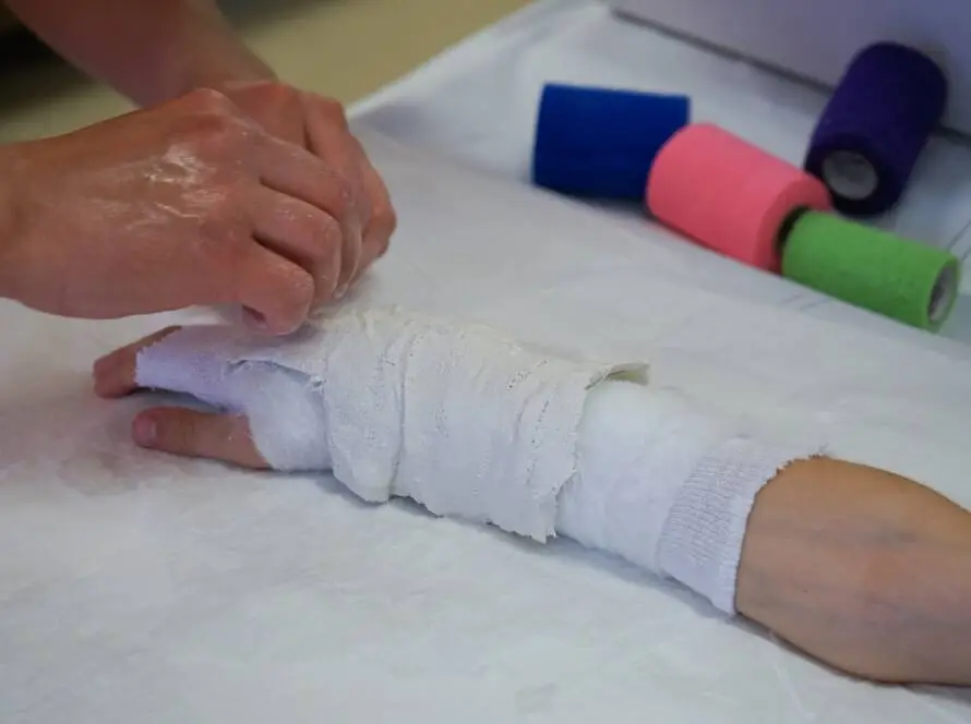 I recently broke my hand